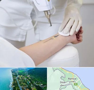 پاک کردن تتو با لیزر در رامسر