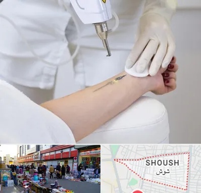 پاک کردن تتو با لیزر در شوش