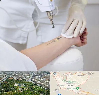 پاک کردن تتو با لیزر در شهرکرد