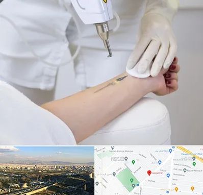 پاک کردن تتو با لیزر در هنگام