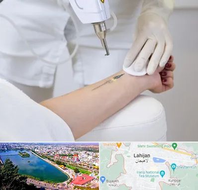 پاک کردن تتو با لیزر در لاهیجان