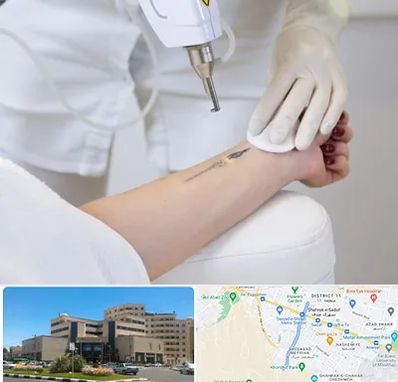 پاک کردن تتو با لیزر در صیاد شیرازی مشهد