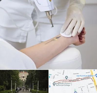 پاک کردن تتو با لیزر در بلوار معلم رشت