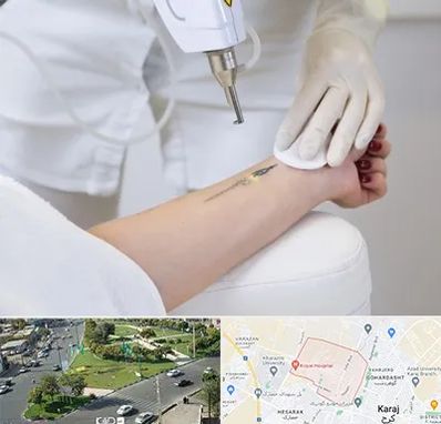 پاک کردن تتو با لیزر در شاهین ویلا کرج