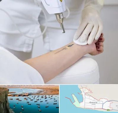 پاک کردن تتو با لیزر در چابهار