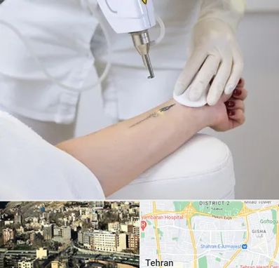 پاک کردن تتو با لیزر در مرزداران