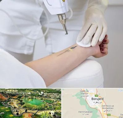 پاک کردن تتو با لیزر در بروجرد