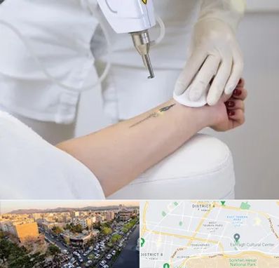 پاک کردن تتو با لیزر در تهرانپارس تهران