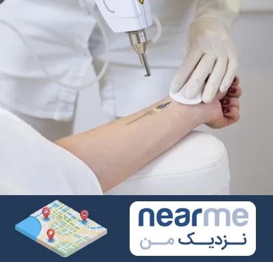 پاک کردن تتو با لیزر در نزدیک من