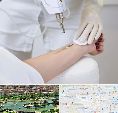 پاک کردن تتو با لیزر در منطقه 9 تهران