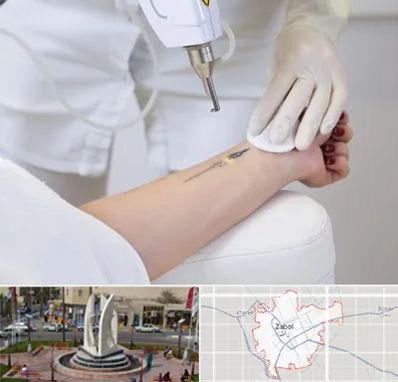 پاک کردن تتو با لیزر در زابل