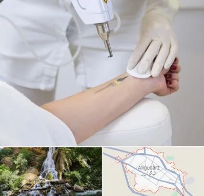 پاک کردن تتو با لیزر در الیگودرز