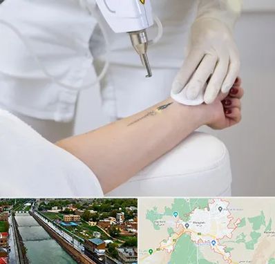 پاک کردن تتو با لیزر در مراغه