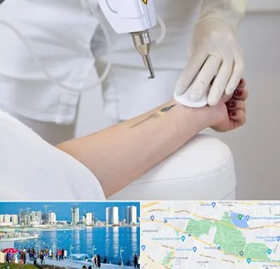 پاک کردن تتو با لیزر در چیتگر