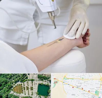 پاک کردن تتو با لیزر در وکیل آباد مشهد