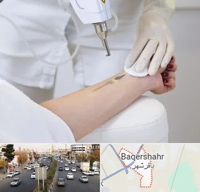 پاک کردن تتو با لیزر در باقرشهر