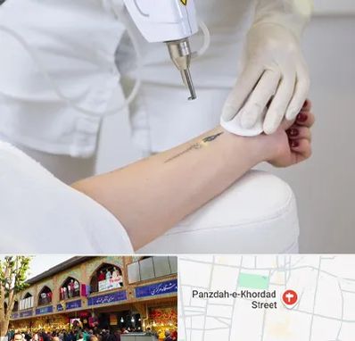 پاک کردن تتو با لیزر در 15 خرداد