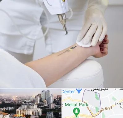 پاک کردن تتو با لیزر در الهیه