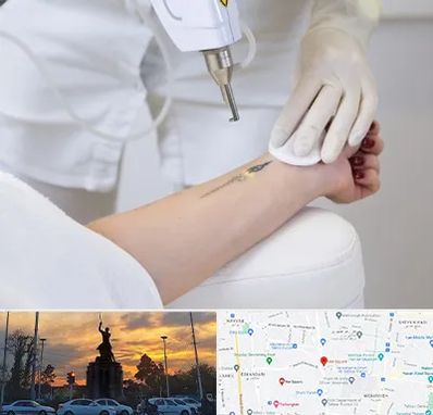 پاک کردن تتو با لیزر در میدان حر