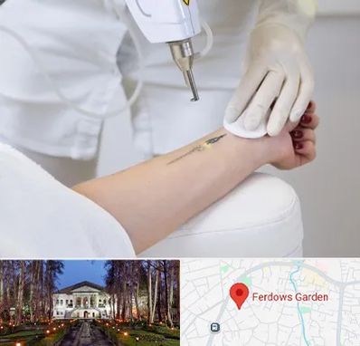 پاک کردن تتو با لیزر در باغ فردوس