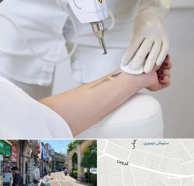 پاک کردن تتو با لیزر در خیابان قزوین