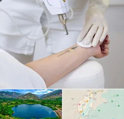 پاک کردن تتو با لیزر در رودبار