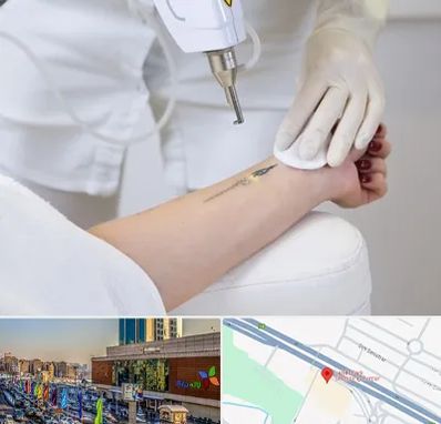 پاک کردن تتو با لیزر در لاله پارک تبریز