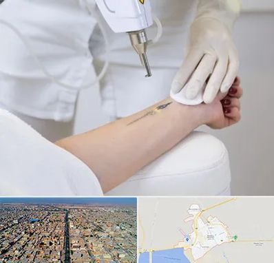 پاک کردن تتو با لیزر در بندر ماهشهر