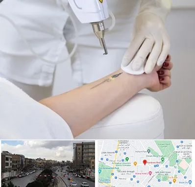 پاک کردن تتو با لیزر در بلوار فردوسی مشهد