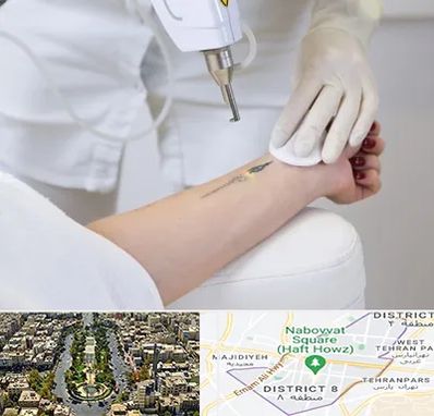 پاک کردن تتو با لیزر در نارمک