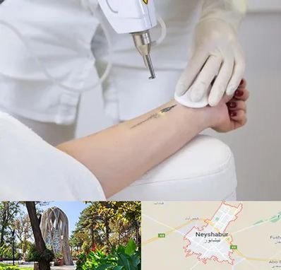 پاک کردن تتو با لیزر در نیشابور