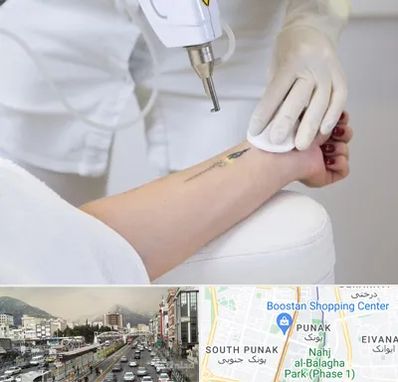 پاک کردن تتو با لیزر در پونک