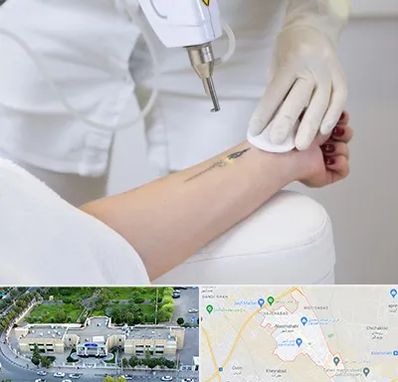 پاک کردن تتو با لیزر در نسیم شهر