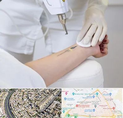 پاک کردن تتو با لیزر در شهرک غرب مشهد