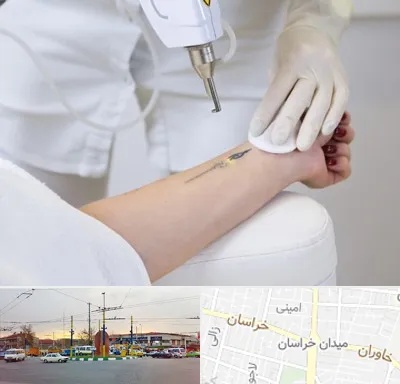 پاک کردن تتو با لیزر در میدان خراسان