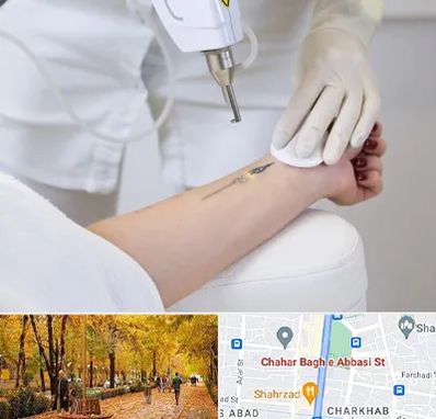 پاک کردن تتو با لیزر در چهارباغ اصفهان