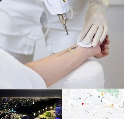 پاک کردن تتو با لیزر در هفت تیر مشهد