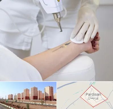 پاک کردن تتو با لیزر در پردیسان قم