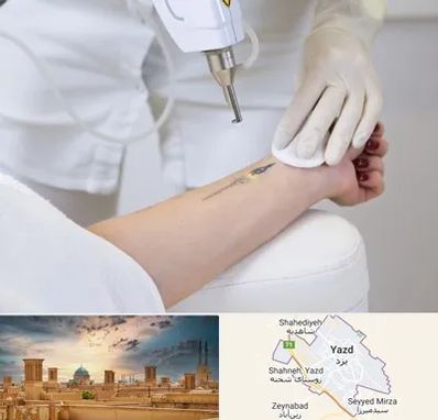 پاک کردن تتو با لیزر در یزد