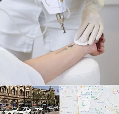 پاک کردن تتو با لیزر در منطقه 11 تهران