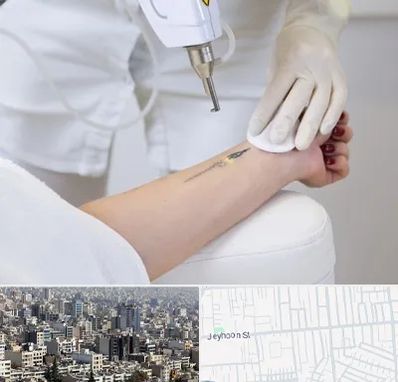 پاک کردن تتو با لیزر در جیحون