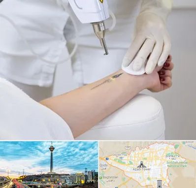 پاک کردن تتو با لیزر در تهران