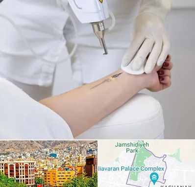 پاک کردن تتو با لیزر در نیاوران