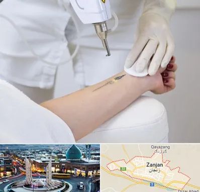 پاک کردن تتو با لیزر در زنجان