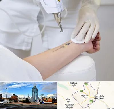 پاک کردن تتو با لیزر در تایباد