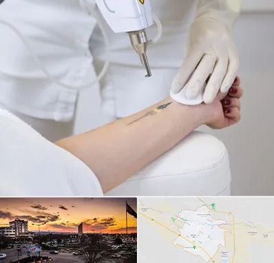 پاک کردن تتو با لیزر در قوچان