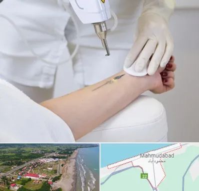 پاک کردن تتو با لیزر در محمودآباد