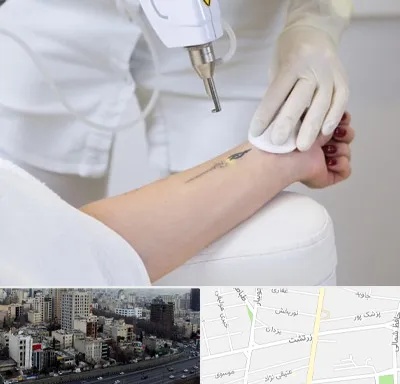 پاک کردن تتو با لیزر در زرتشت