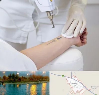 پاک کردن تتو با لیزر در قروه