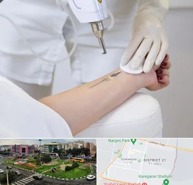 پاک کردن تتو با لیزر در تهرانسر